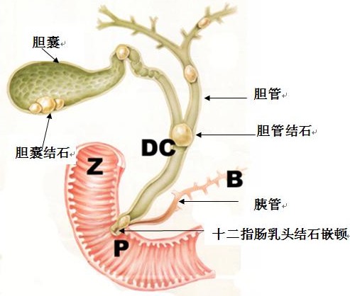 疑似胆管癌应该如何诊断