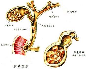 食用哪些食物对胆管癌护理较好?