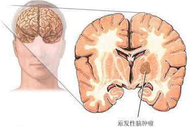 早期脑瘤怎么治疗好? 早期脑瘤怎么治疗好?