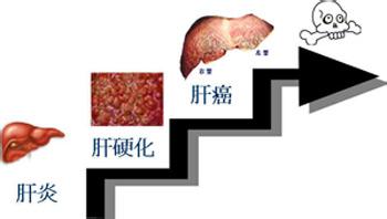 肝上长瘤是怎么回事 肝上长瘤是怎么回事