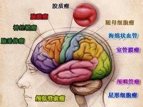 胶质瘤分类 胶质瘤分类