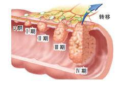 肝部瘤的主要症状 肝部瘤的主要症状