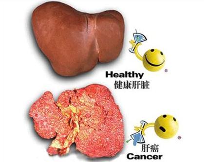 肝癌有哪些危害性 肝癌有哪些危害性